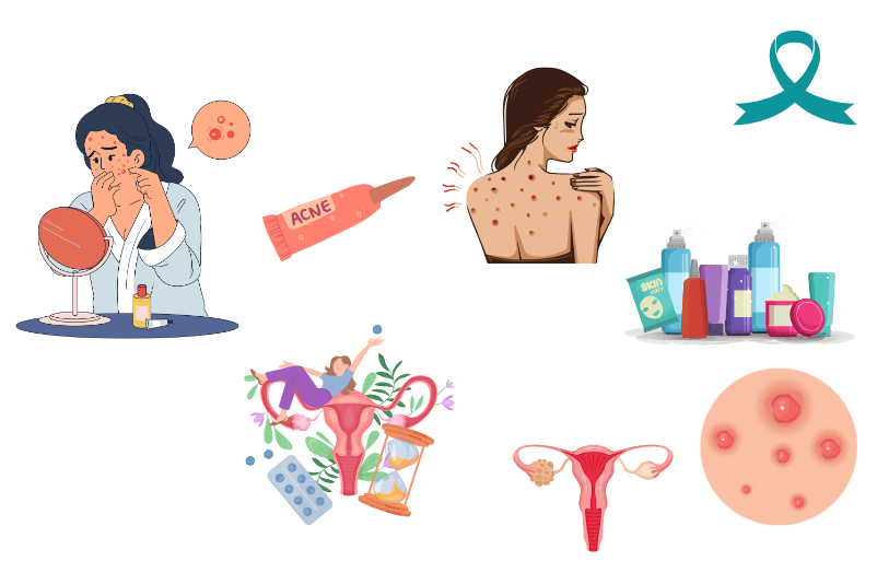 Mon long combat contre l’acné hormonale causée par le SOPK